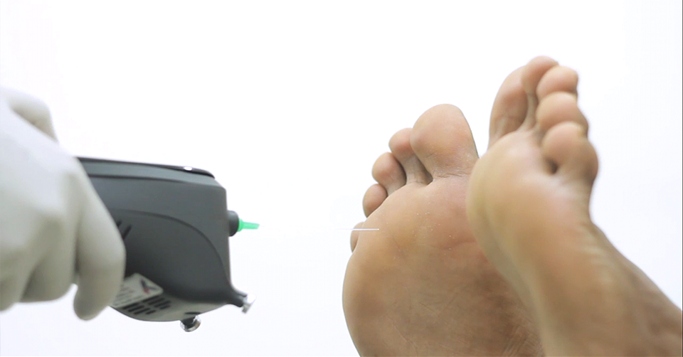 Complete Neuropathy Evaluation: Biothesiometry and 4 Complementary Tests